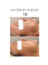 ココロ(KoKoRo)/肌質改善ハーブトリートメント