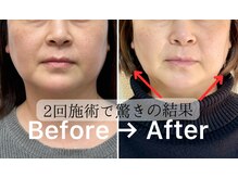 ルース(Luce)/速攻小顔【3Sグローブエステ】