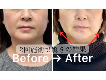 ルース(Luce)/速攻小顔【3Sグローブエステ】