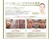 ヴィーナスハンド/ハ-バルシ-（ハーブピーリング）