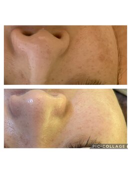 エクシア(ECXIA)/モヤモヤシミもビタミンケア