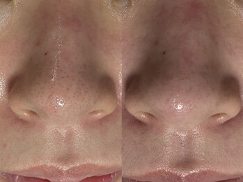 リボーン(REBORN)/ハーブピーリングで毛穴洗浄