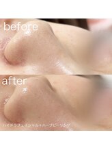 ルルラ リコ(lulula rico)/症例写真/ハイドラ毛穴洗浄