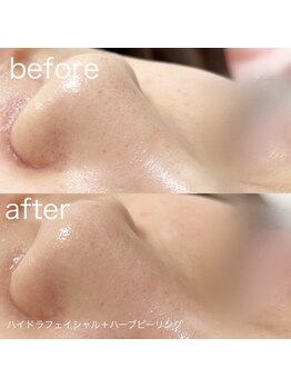 ルルラ リコ(lulula rico)/症例写真/ハイドラ毛穴洗浄