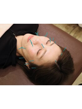 鍼灸施術を受けたい