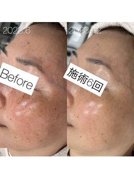 イリス(Iris)/大人のシミ改善は複雑ですが