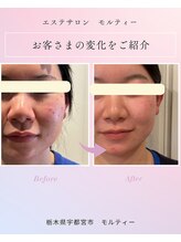 モルティー 宇都宮店(Molti)/ニキビケア