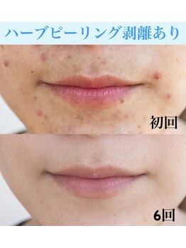 ソアン(Soin)/継続が大事です。