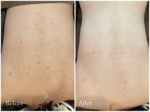 ライフ美容整体院 恵比寿(Life美容整体院)/背中ハーブピーリング