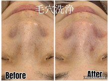 アンドエミニー エン ラボーテ(& EMINY 艶 la beaute)の雰囲気（角質を浮かせて吸引！毛穴洗浄！）