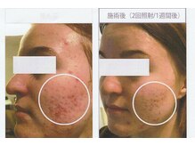 デジールの雰囲気（【メンズプラズマニキビケア】角質・脂質除去/毛穴縮小/減菌作用）