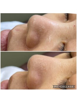 ウイ 津幡店(Ui)/毛穴洗浄