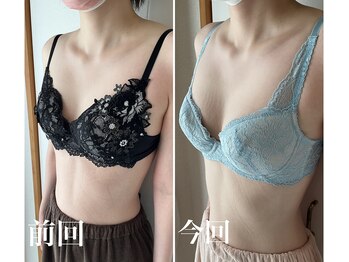 美バストアルファ(美bust α)/【バストアップ】症例