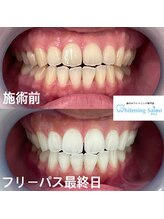 ホワイトニングサロン 熊本店/人気セルフホワイトニング