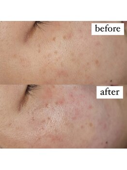 テンパ ビューティー(+10%beauty)/一撃タマゴ肌ワックス