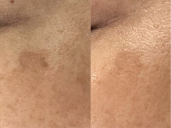 リシア(RECIA)/シミケア<施術前/5回目>