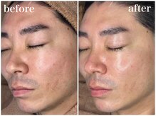 ホワイトアクア 天王寺本店(WHITE AQUA)/ララピールでツヤ肌に/大阪