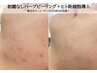 美容液導入【頑固なニキビ・毛穴ケア】REVI陶肌ハーブ＋ヒト幹細胞導入 ¥9900
