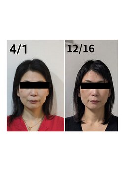 ミヤビ(miyabi)/小顔矯正