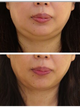 デイスパ ヴィータの写真/【スタッフもやりたい】冬から春先の二重アゴ、むくみ撃退ケア！福井でここだけ☆プラズマで美人育て。