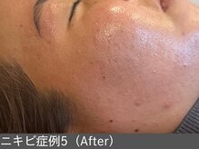 オアシスラグーン(OASIS LAGOON)/ニキビ改善（症例5 after）