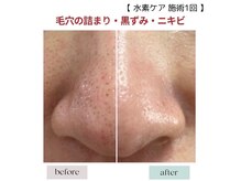 ハイケア グラン ギンザ(HYCARE GRAND GINZA)/ツルツルの小鼻へ！/銀座/東銀座