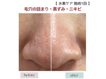 ハイケア グラン ギンザ(HYCARE GRAND GINZA)/ツルツルの小鼻へ！/銀座/東銀座