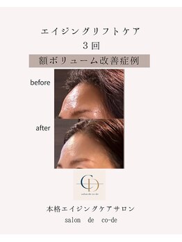 サロンドコーデ(salon de co-de)/エイジングリフトケア