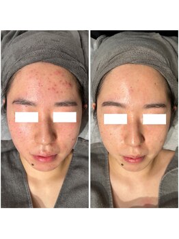 サロン ウーカ(salon WOOCA)/REVI陶肌トリートメント