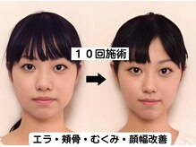 ニュートラル 渋谷店(NEUTRAL)/小顔矯正結果［小顔/骨盤］