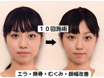 ニュートラル 渋谷店(NEUTRAL)/小顔矯正結果［小顔/骨盤］
