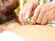 武蔵小杉優和の雰囲気（鍼（はり）の施術）