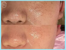 ヴィオール 名古屋栄店(VIOR)/オススメ　テテピール　毛穴改善