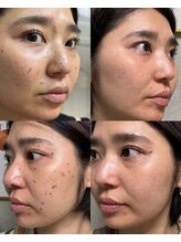サロン ベベ(Salon Bebe)/最新シミケア！ホワイトラボ
