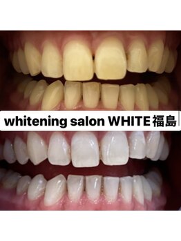 ホワイトニングサロン ホワイト(WHITE)/セルフホワイトニング☆効果