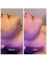 アムスパ(Aum Spa)/フォースカッターface