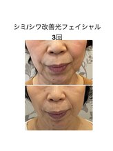 ココロ(KoKoRo)/シミ/シワ改善光フェイシャル