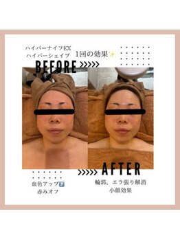 ラウレア(Laure'a)/ハイパーナイフEX/シェイプ