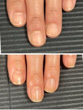 ルカロンネイル(Rukaron Nail)/縦筋と縦に亀裂が入ってしまう爪