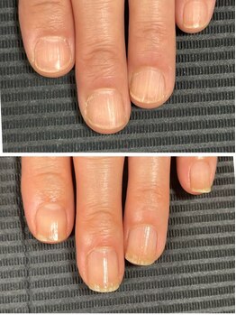 ルカロンネイル(Rukaron Nail)/縦筋と縦に亀裂が入ってしまう爪