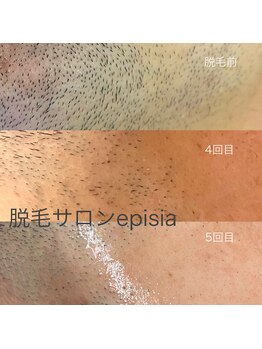 フェリーチェネイル(felice Nail)/ヒゲ脱毛