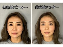 至福の空間 まごのて/【電気あり美容鍼】ビフォアフタ