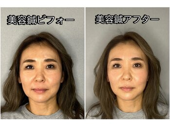 至福の空間 まごのて/【電気あり美容鍼】ビフォアフタ