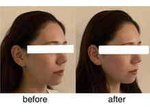 アンドリードット 堀江(&re.)/フェイスラインの変化