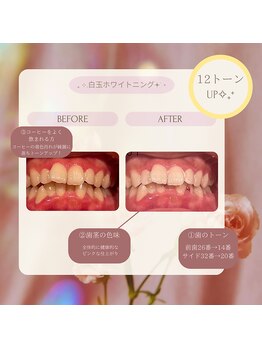 プラスビーセルフ(+b self)/ホワイトニングビフォーアフター