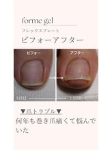 プリード 日進香久山店(PULIDO)/巻き爪ケア