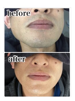 エアリアル 八代店/髭脱毛