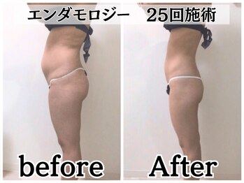 イデアルボーテ/エンダモロジーボディ