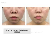 ビューティーラウンジ 自由が丘(BeautyLounge)/クリアグロウ光フェイシャル