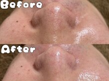 グラシア 倉敷店(Gracia)/ハイドラ毛穴洗浄